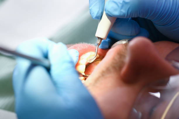 Best Emergency Dental Care for Broken or Chipped Teeth in Chillicothe, OH
